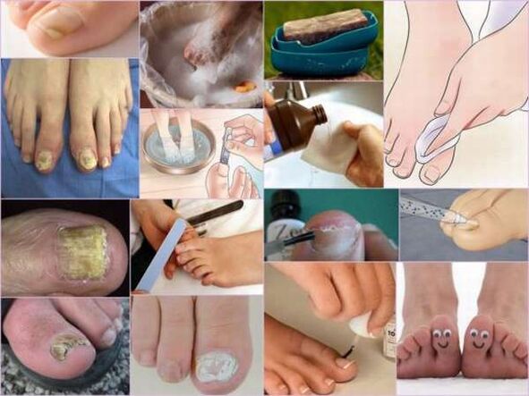 hongos en las uñas de los pies y su tratamiento con barniz