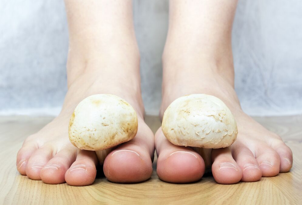 Hongos comunes en las uñas de los pies